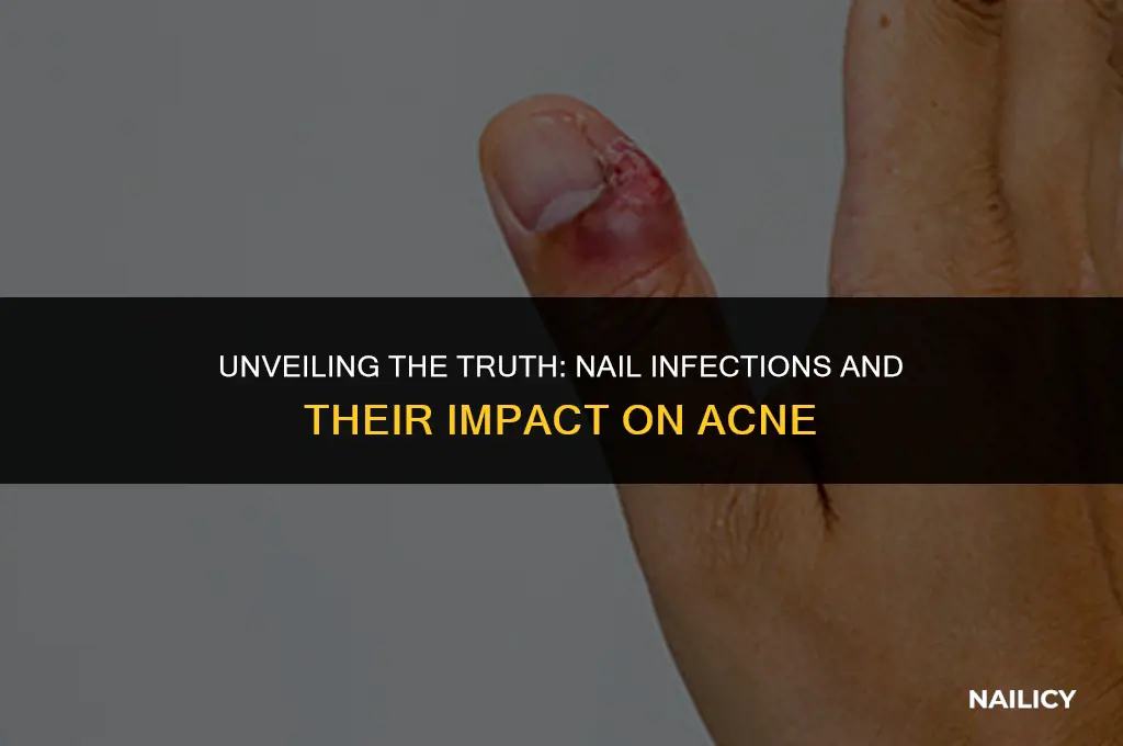 can nail infections cause acne