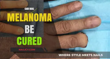 Hope and Healing: The Journey to Curing Nail Melanoma