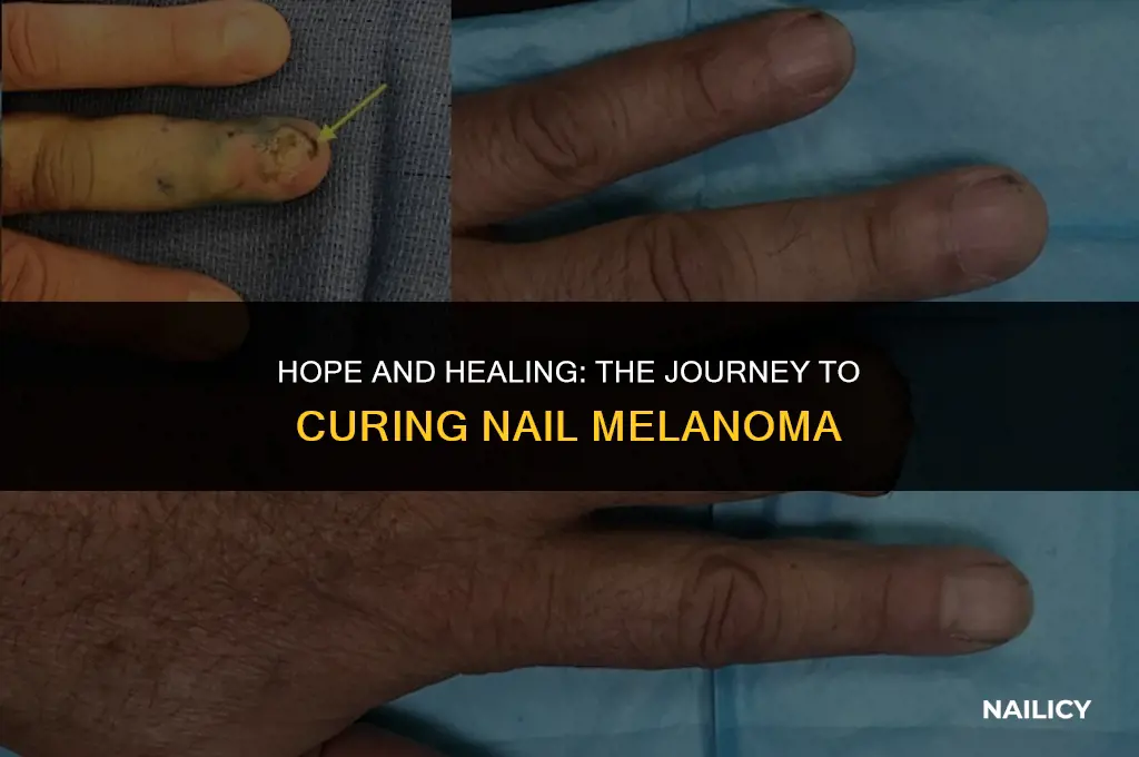 can nail melanoma be cured