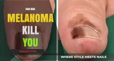 Understanding Nail Melanoma: Risks, Symptoms, and Treatment Options