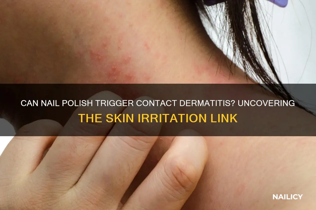 can nail polish cause contact dermatitis