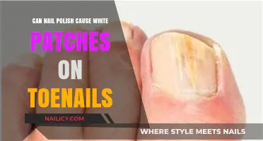Can Nail Polish Cause White Patches on Toenails? Explained