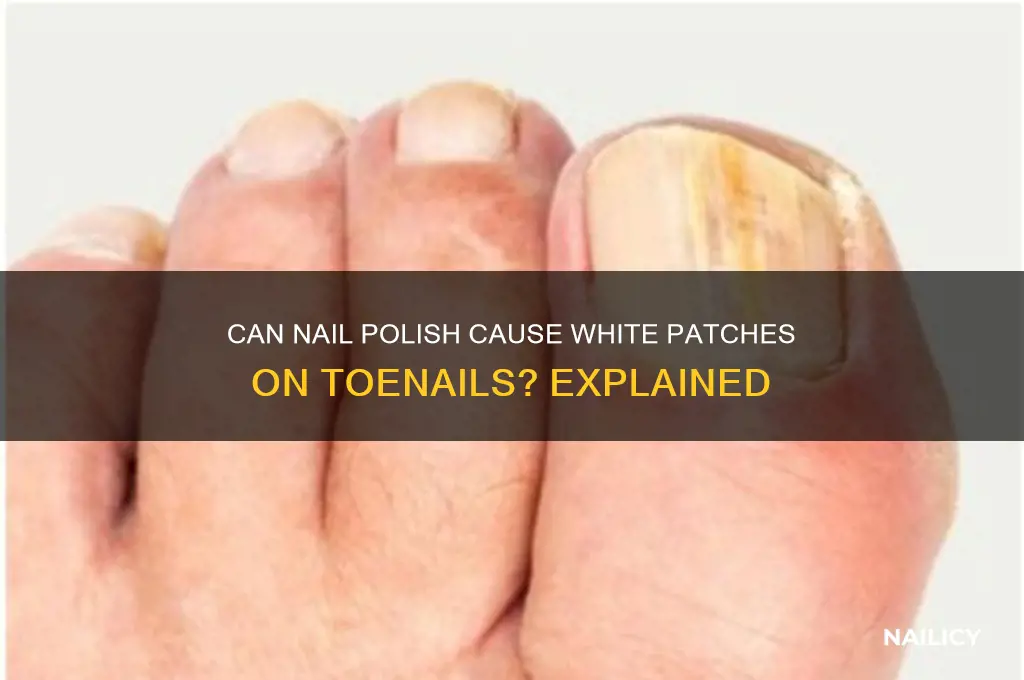 can nail polish cause white patches on toenails