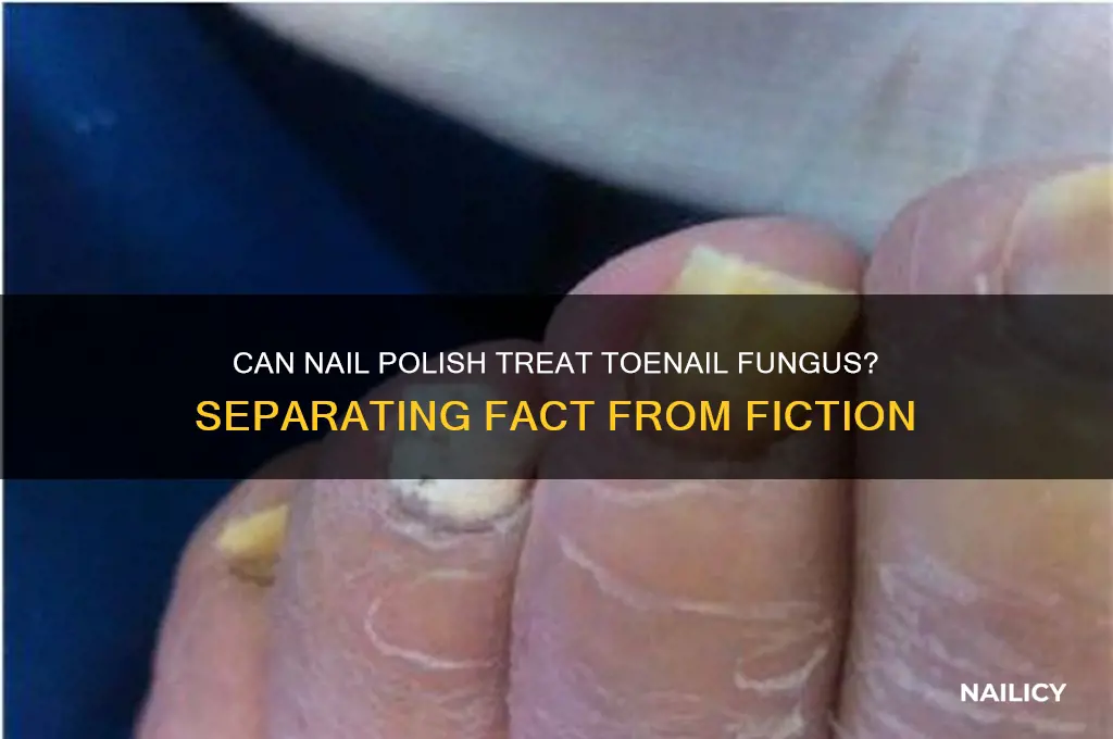 can nail polish cure nail fungus
