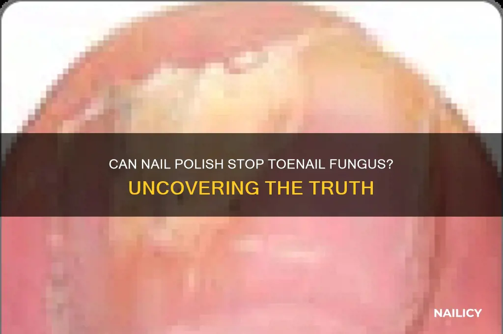 can nail polish inhibit toenail fungus