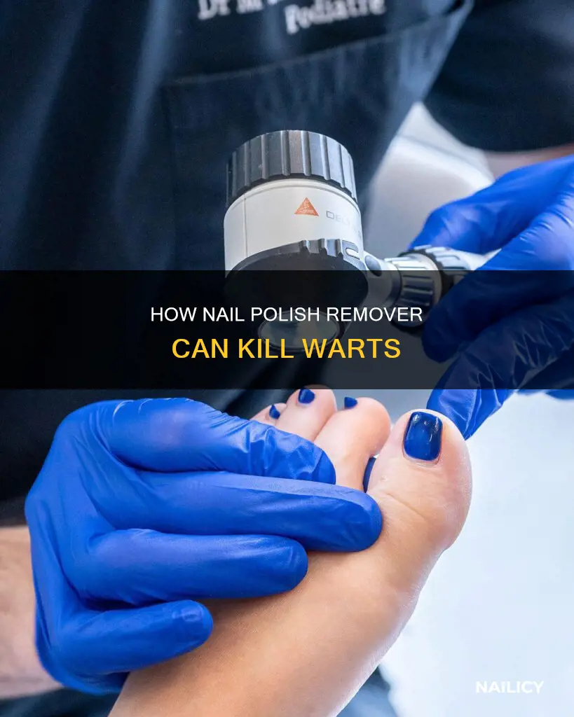 can nail polish remover kill warts