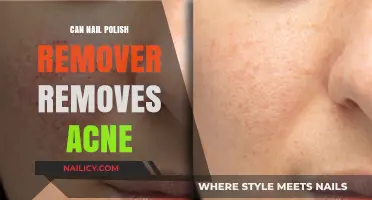 Nail Polish Remover: An Acne Treatment?