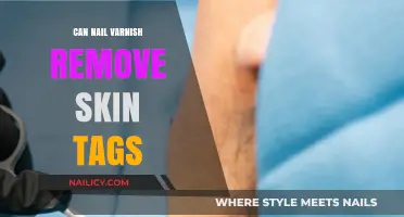 How Nail Varnish Can Remove Skin Tags