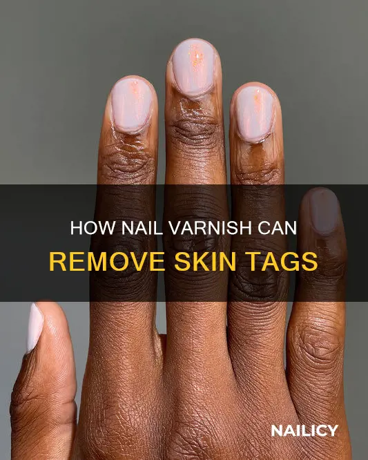 can nail varnish remove skin tags
