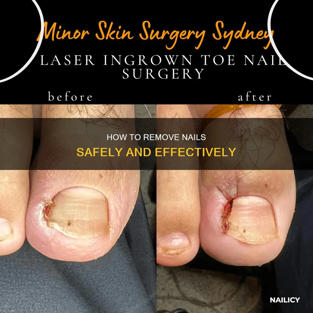 can nails be removed