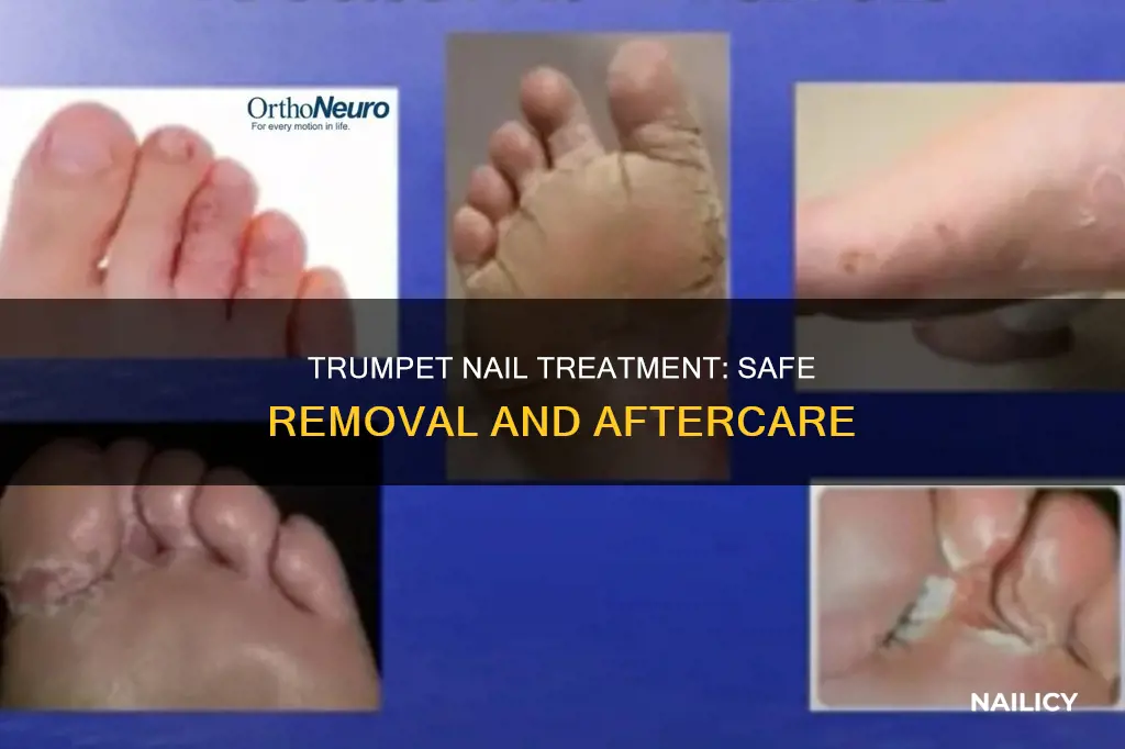 can removal of trumpet nail treatment