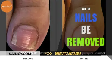 Toe Nail Removal: Is it Possible?
