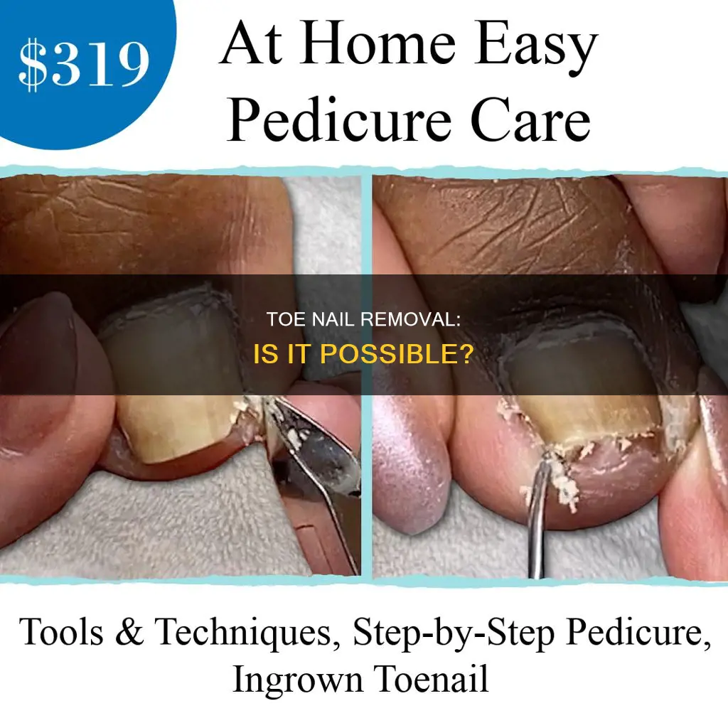 can toe nails be removed