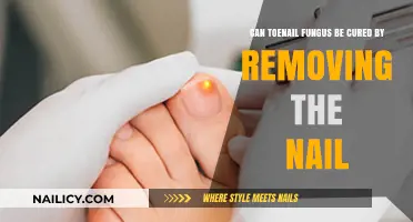 Killing Toenail Fungus: Does Removing the Nail Help?