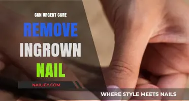 Ingrown Nail Removal: Urgent Care's Quick Fix