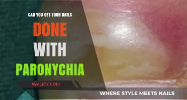 Nail Care Quandary: Can You Get Your Nails Done with Paronychia?