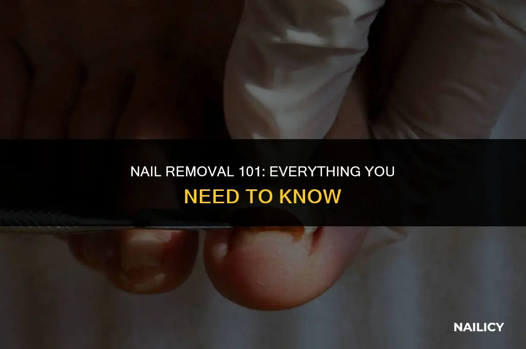 can you get your nails removed