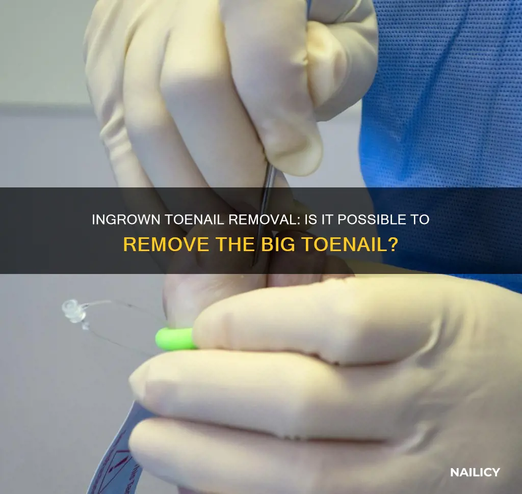 can you have big toe nail removed for ingrown