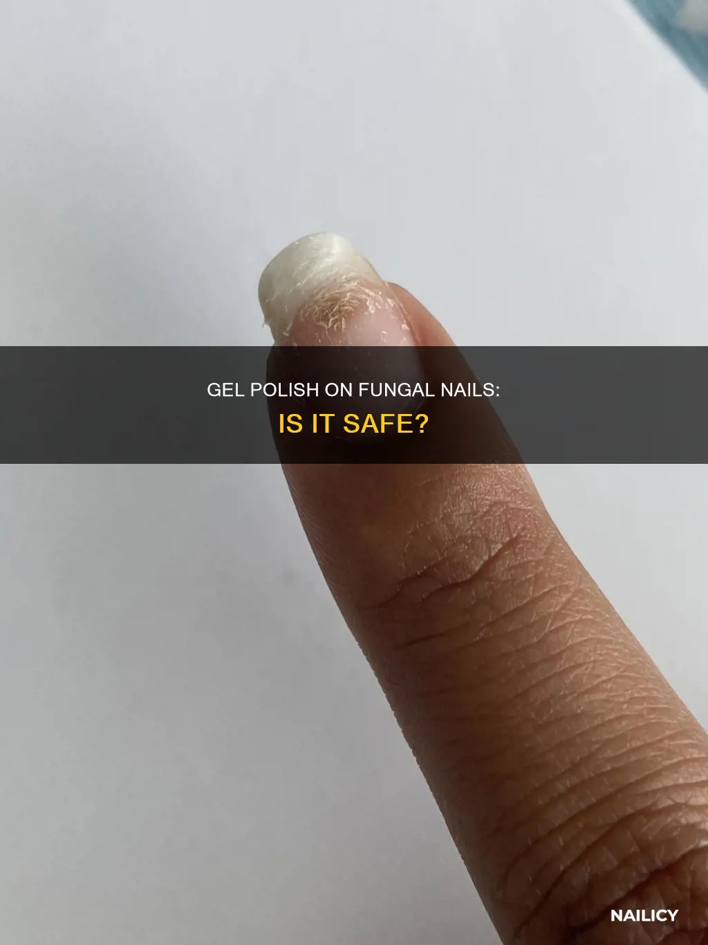 can you put gel polish on fungal nail fungus