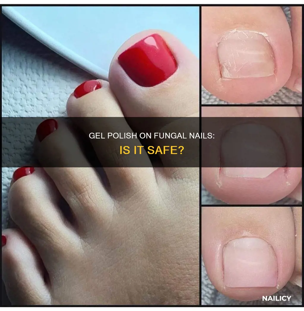 can you put gel polish on fungal nail
