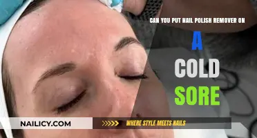 Nail Polish Remover: Cold Sore Treatment or Myth?