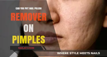 Nail Polish Remover: A Pimple Treatment?