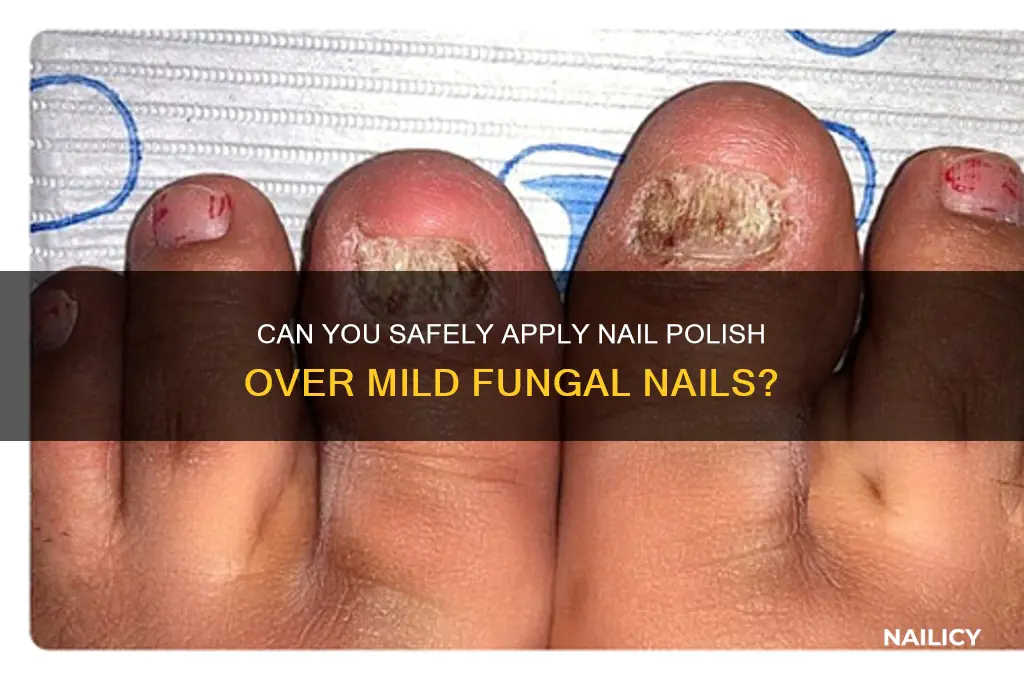 can you put polish over a mild fiungus nail