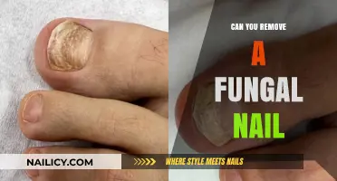 Eradicating Fungal Nails: Is It Possible?