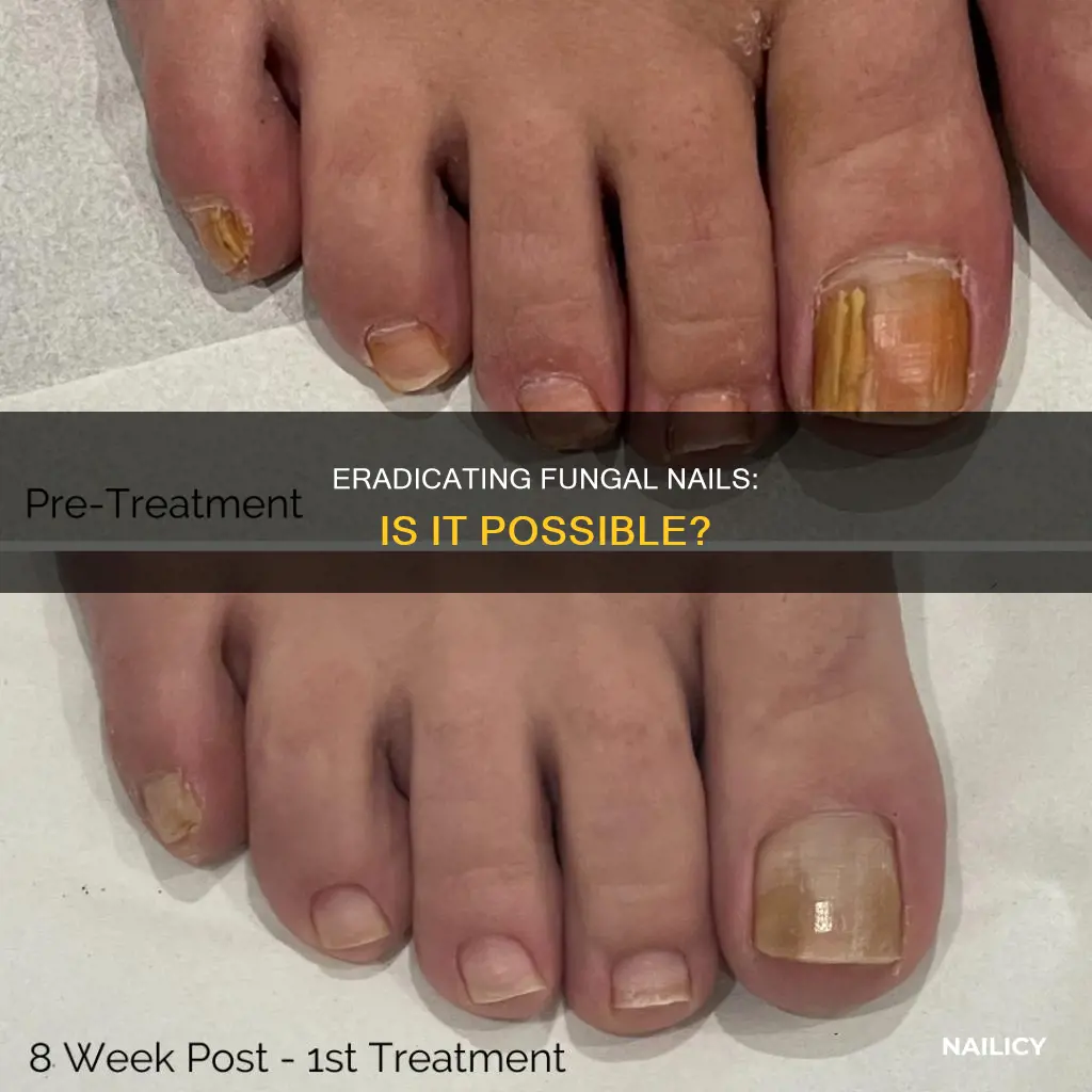 can you remove a fungal nail