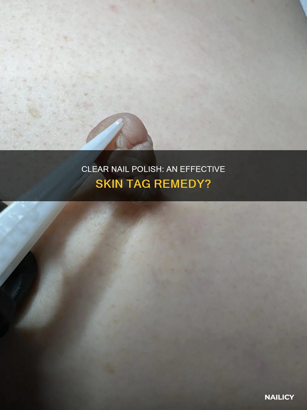can you remove skin tags with clear nail polish