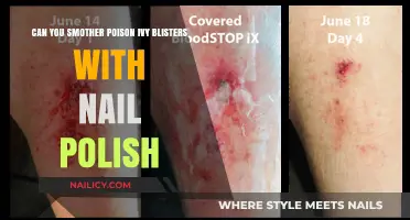 Smothering Poison Ivy Blisters with Nail Polish: Myth or Effective Remedy?