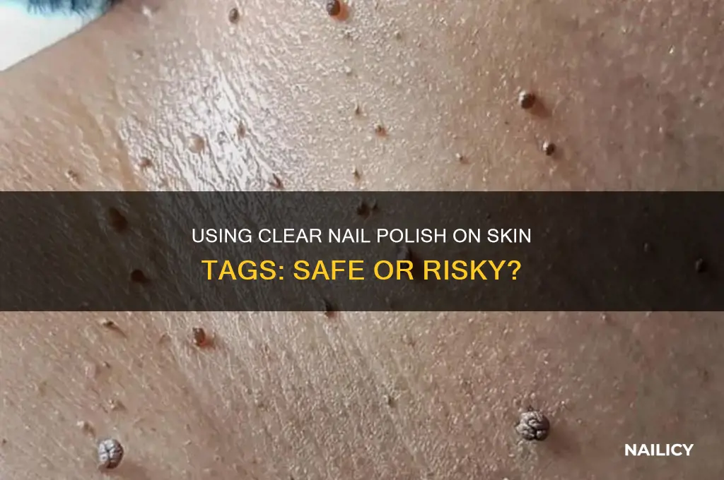 can you use clear nail polish on skin tags