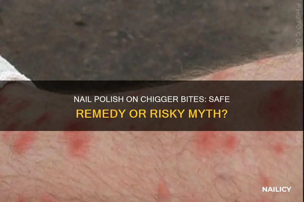 can you use nail polish on chigger bites