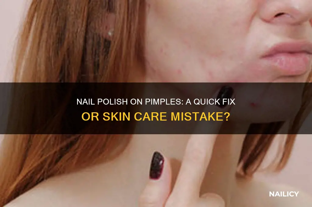 can you use nail polish on pimples