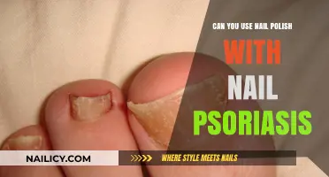 Nail Polish and Psoriasis: Safe Usage Tips for Healthy Nails