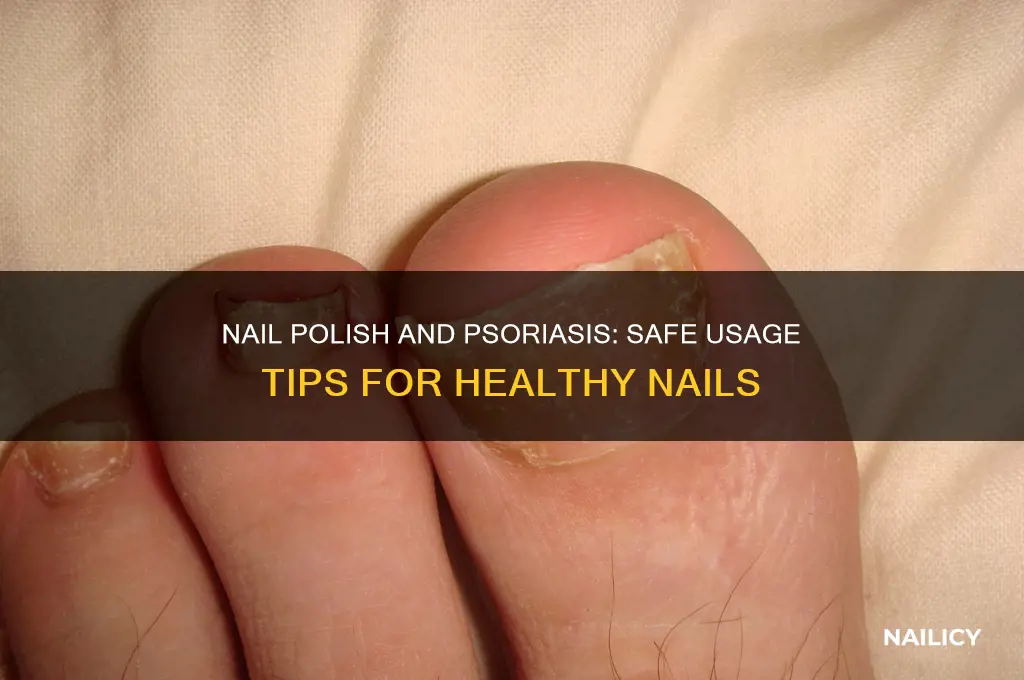 can you use nail polish with nail psoriasis