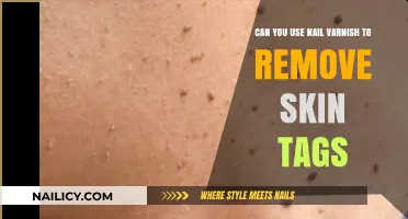 Nail Varnish: A Quick Fix for Skin Tags?