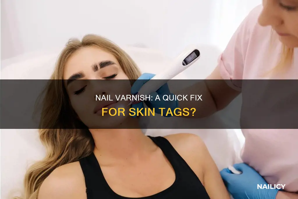 can you use nail varnish to remove skin tags