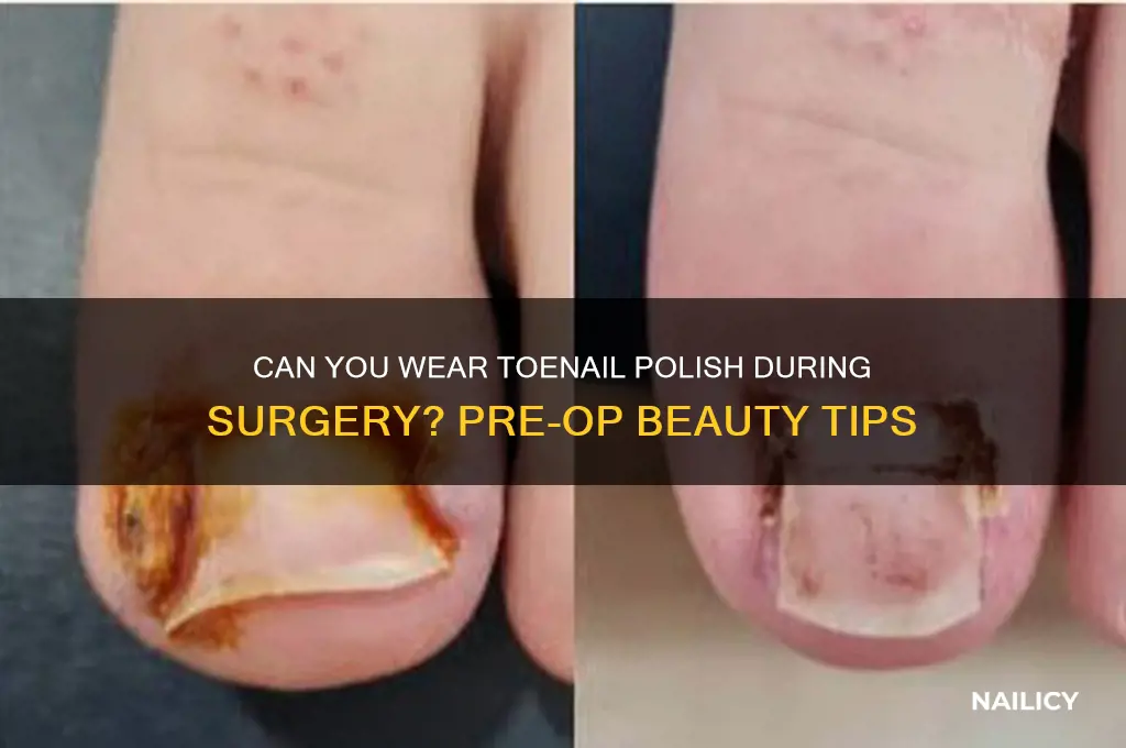 can you wear toe nail polish during surgery