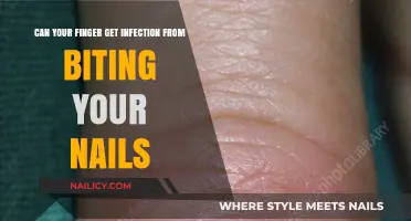 Biting Your Nails: A Hidden Risk of Finger Infections