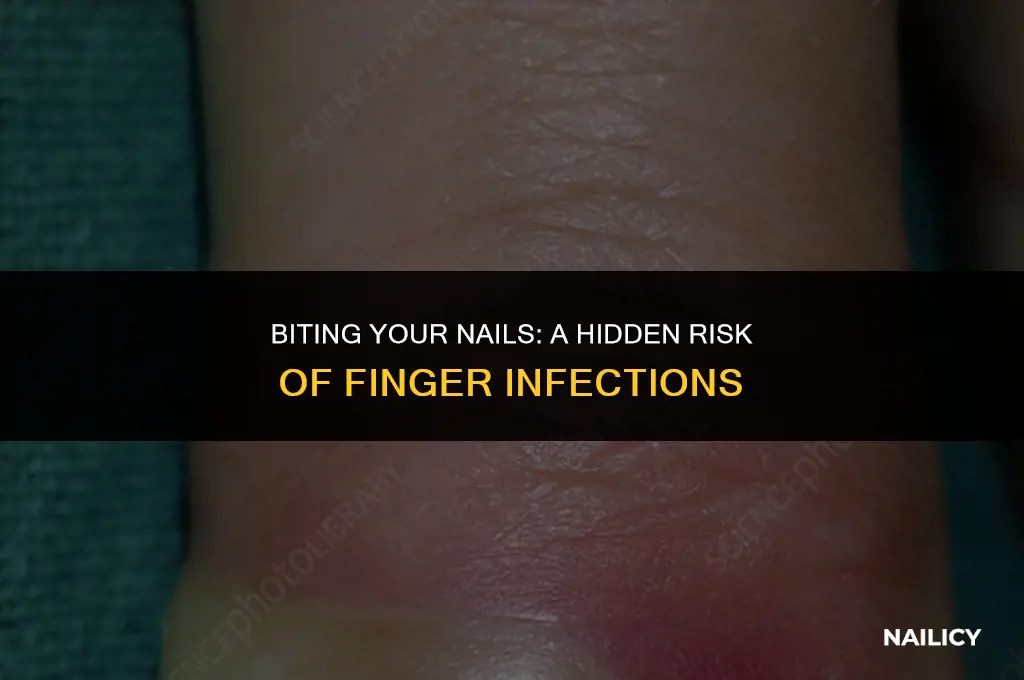 can your finger get infection from biting your nails