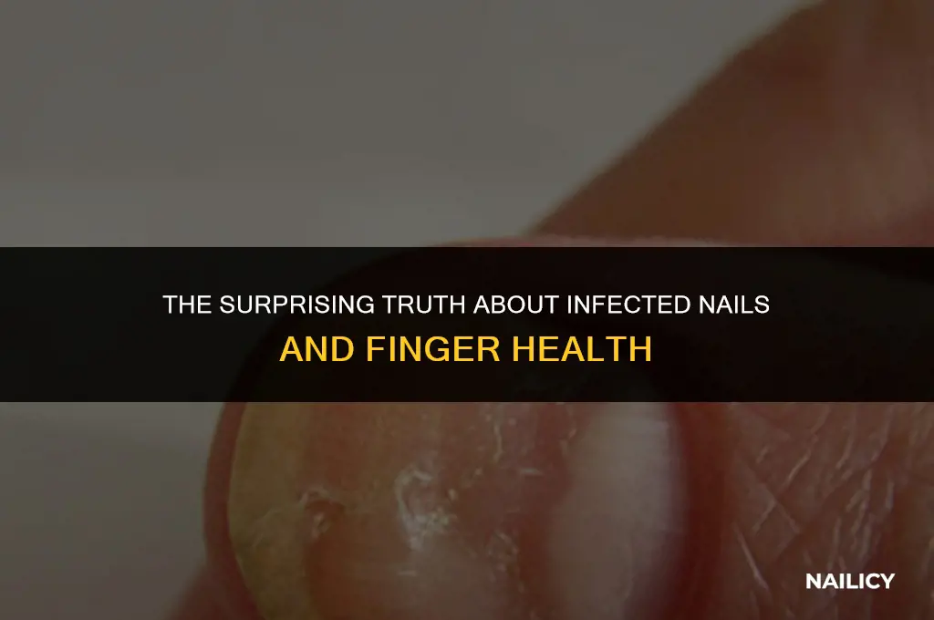 can your fingers fall off if your nail gets infected