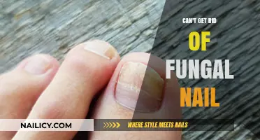 Persistent Fungal Nail Infections: Causes, Treatments, and Prevention Tips