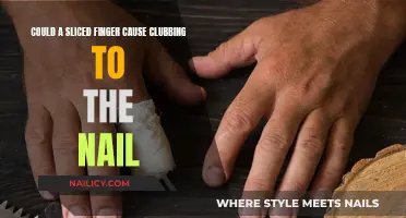 Sliced Finger Clubbing: What You Need to Know