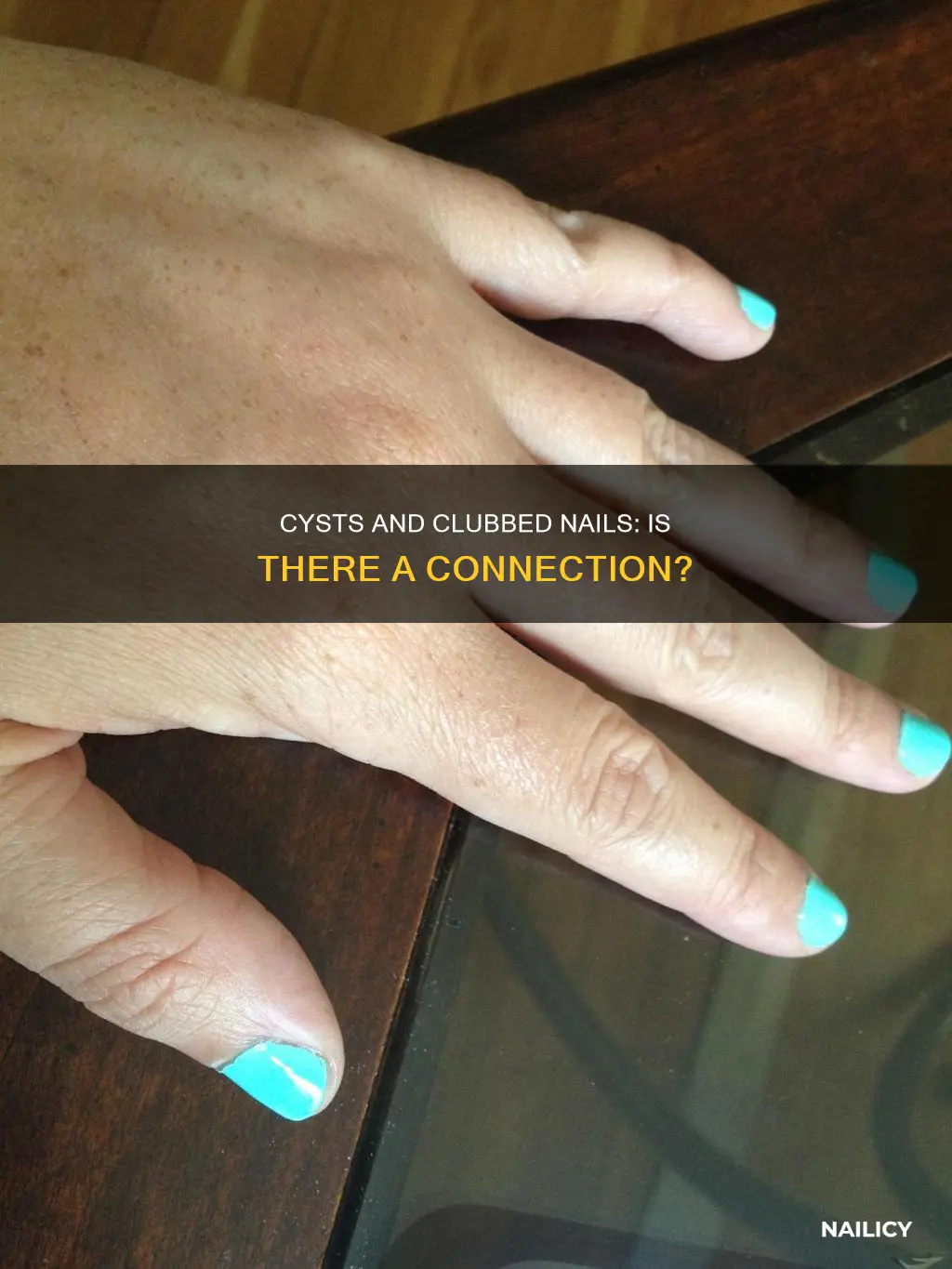 could cycst also cause club finger nails
