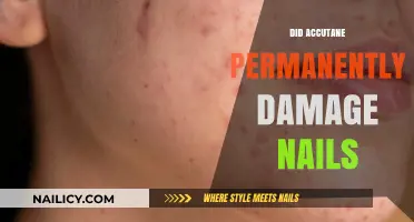 Accutane and Nail Health: Long-Term Effects and Permanent Damage Concerns