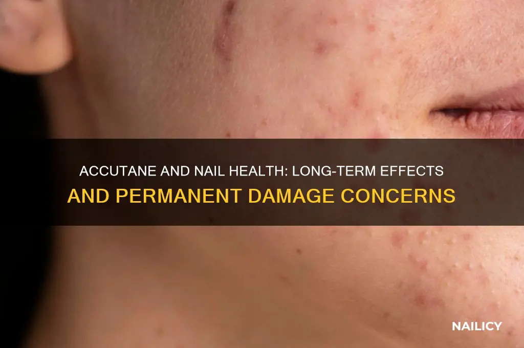 did accutane permanently damage nails