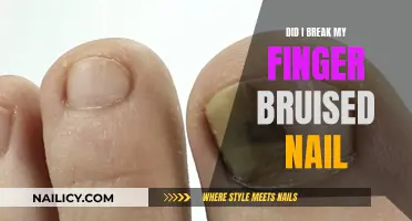 Bruised Nail, Broken Finger: What Does It Mean?