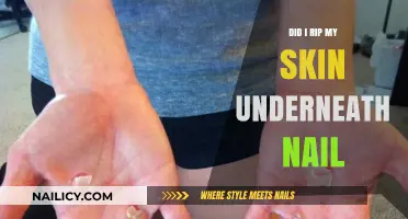 Ouch! Did I Rip My Skin Underneath My Nail? Here's What to Do