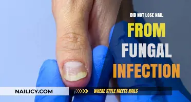Surviving Fungal Infection: How I Saved My Nail from Falling Off
